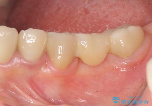 清掃しづらく、見た目の気になるブリッジの治療後
