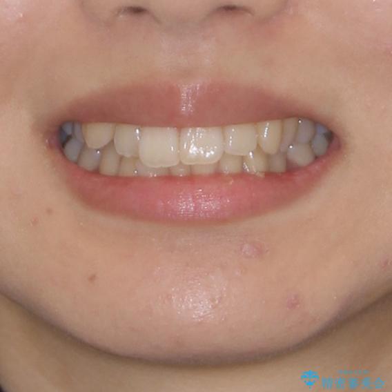 インビザラインでスッキリとした口元にの治療前(顔貌)