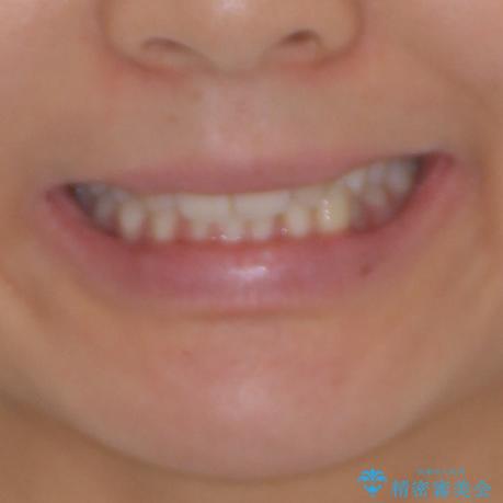 上顎前歯が2本欠損 インビザラインによる叢生の解消の治療前(顔貌)
