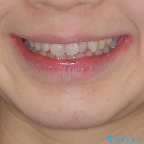 前歯のデコボコを改善 目立たないワイヤー矯正の治療前(顔貌)