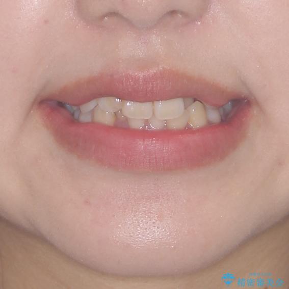 短期間で終了 デコボコをワイヤー矯正で解消の治療前(顔貌)