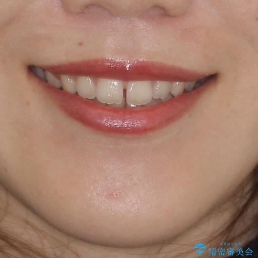 気になる隙間の再矯正 前歯をインビザライン・ライトで改善の治療前(顔貌)