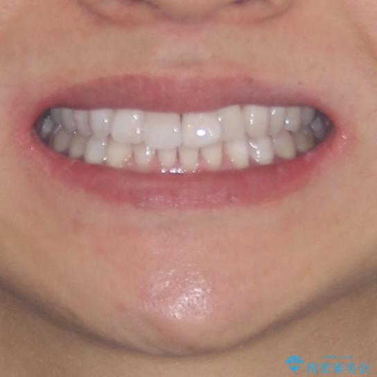 前歯のデコボコを治したい インビザラインによる矯正治療の治療前(顔貌)