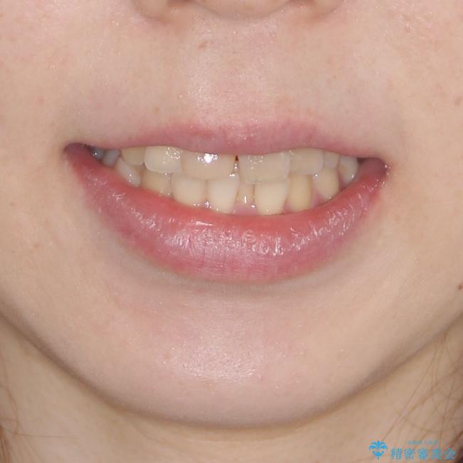 抜歯矯正の後戻り インビザラインによるオープンバイトの再矯正の治療前(顔貌)