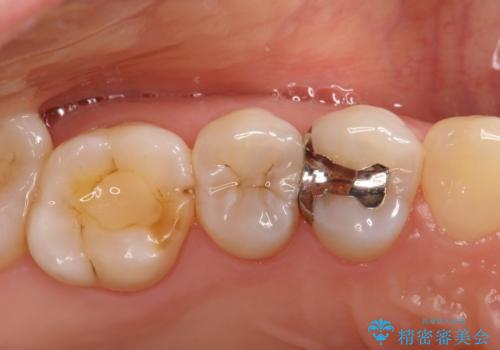 【セラミックインレー】むし歯の治療の症例 治療前