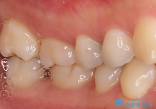 【セラミックインレー】むし歯の治療の治療前