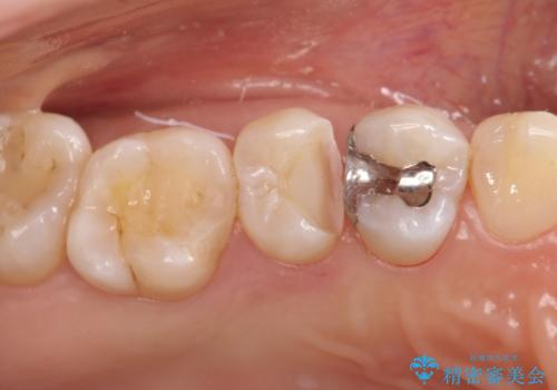 【セラミックインレー】むし歯の治療の治療中