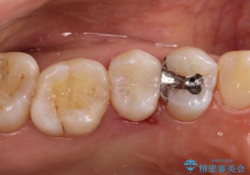 【セラミックインレー】むし歯の治療の症例 治療後