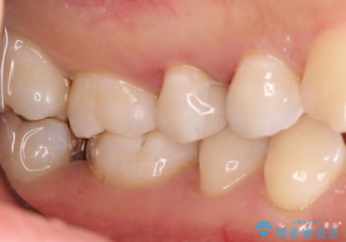 【セラミックインレー】むし歯の治療の治療後