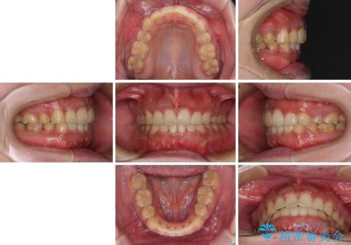 口元の突出感を改善　ワイヤー装置による抜歯矯正の治療後