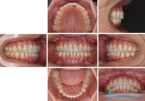 前歯のデコボコを治したい インビザラインによる矯正治療の治療後