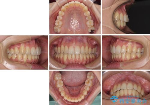 インビザラインでスッキリとした口元にの治療後