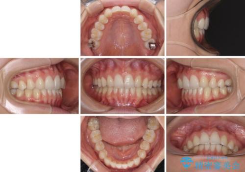 上顎前歯が2本欠損 インビザラインによる叢生の解消の治療後