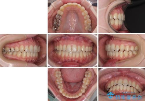 前歯のデコボコを改善 目立たないワイヤー矯正の治療後