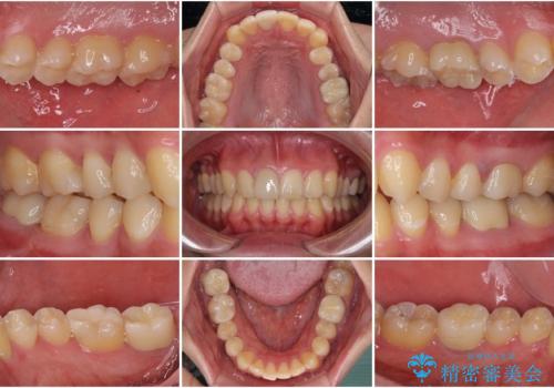 銀歯を白くしたい セラミックによる審美歯科治療の治療後