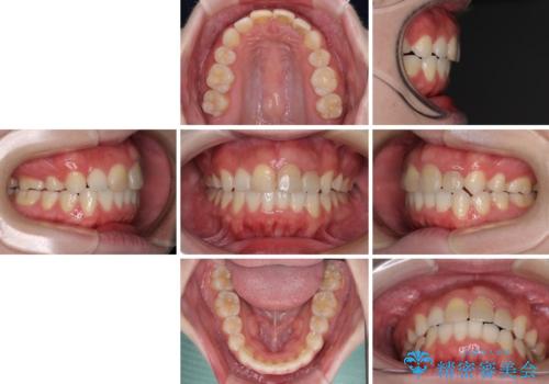 抜歯矯正の後戻り インビザラインによるオープンバイトの再矯正の治療後