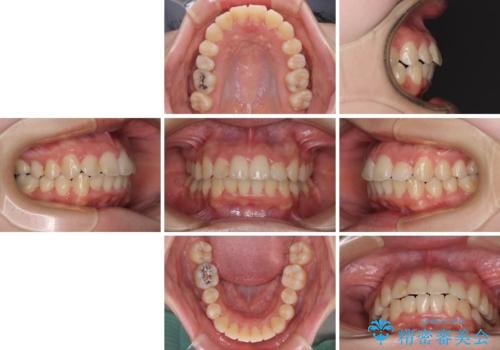 短期間で終了 デコボコをワイヤー矯正で解消の治療後