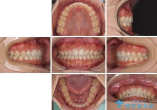 気になる隙間の再矯正 前歯をインビザライン・ライトで改善の治療後