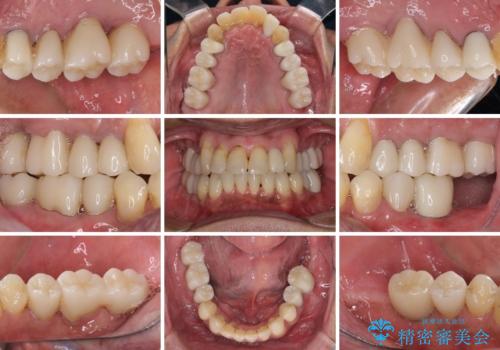 歯列不正と歯周病 総合歯科治療による全顎治療の治療後