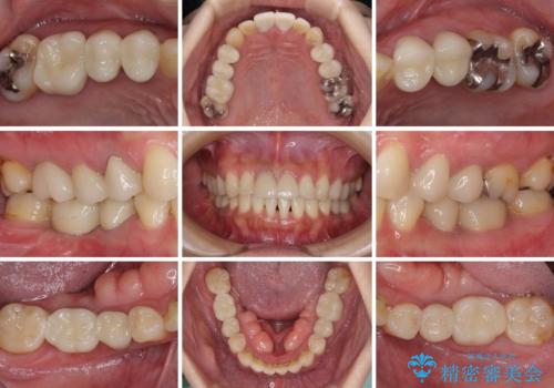 気になる部分を全て治療 総合歯科治療で口腔内環境改善の治療後