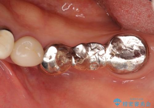 清掃しづらく、見た目の気になるブリッジの治療前