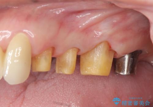 歯ぎしりに抵抗する歯周補綴 インプラント補綴の治療中