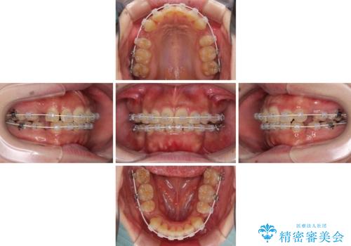 口元の突出感を改善 ワイヤー装置による抜歯矯正の治療中