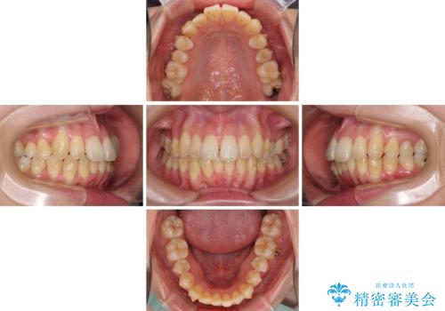 インビザラインでスッキリとした口元にの治療中