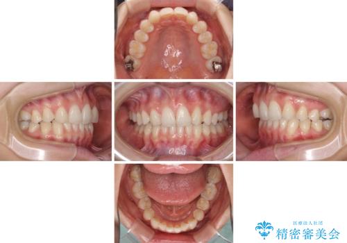 上顎前歯が2本欠損 インビザラインによる叢生の解消の治療中