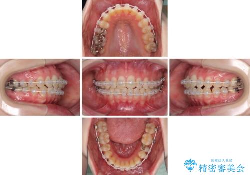 前歯のデコボコを改善 目立たないワイヤー矯正の治療中