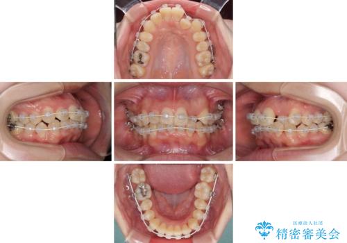 短期間で終了 デコボコをワイヤー矯正で解消の治療中