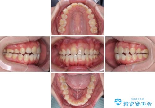 抜歯矯正の後戻り インビザラインによるオープンバイトの再矯正の治療中