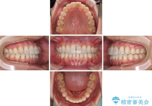 前歯のデコボコを治したい インビザラインによる矯正治療の治療中