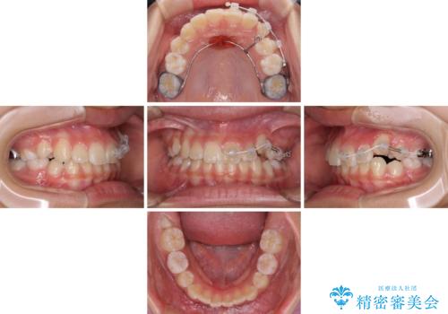 埋もれた犬歯を引っ張り出す 小学生のⅠ期治療の治療中