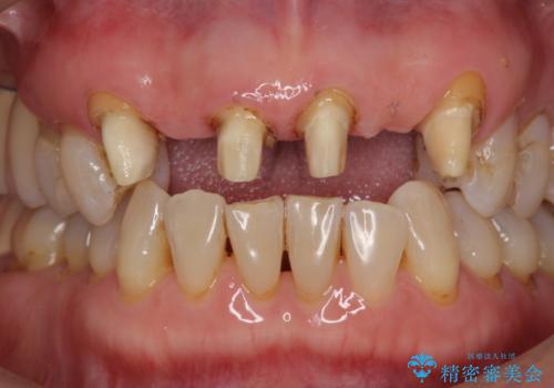 不自然な前歯ブリッジ ジルコニアブリッジによるやり替えの治療中