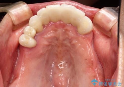 「しっかり噛める入れ歯」インプラントオーバーデンチャーの症例 治療前