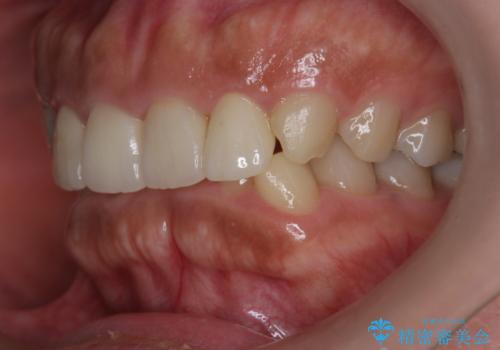 割れにくいセラミック治療 フルジルコニアクラウンの治療後