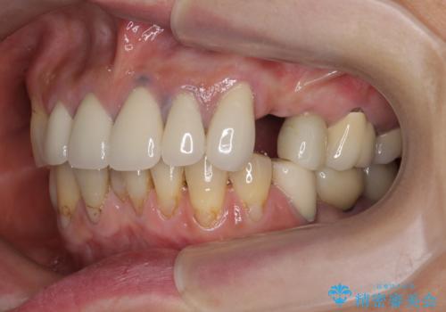 [ノンクラスプデンチャー]  バネの見えない審美的な入れ歯の症例 治療前