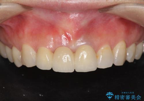 [抜歯時の顎堤保存]  審美的なブリッジ製作の症例 治療後