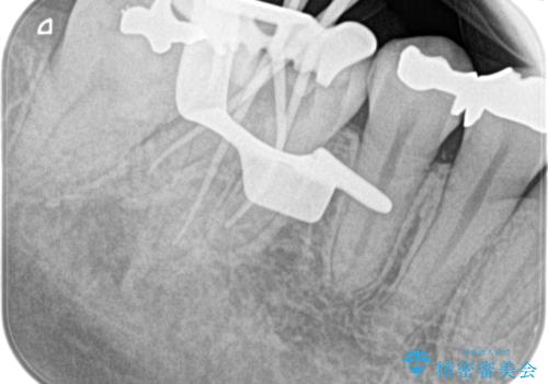 【根管治療】昨日から眠れないぐらい歯が痛いの治療後