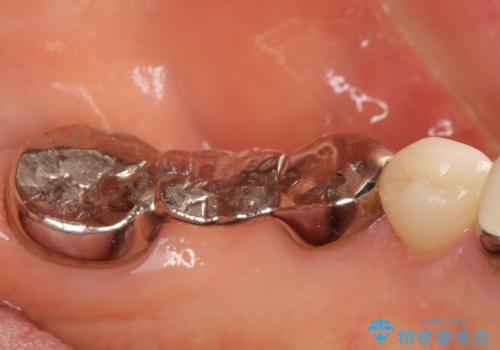 清掃しづらく、見た目の気になるブリッジの治療前