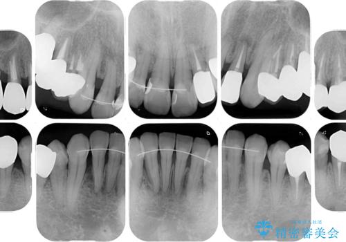 歯列不正と歯周病 総合歯科治療による全顎治療の治療後