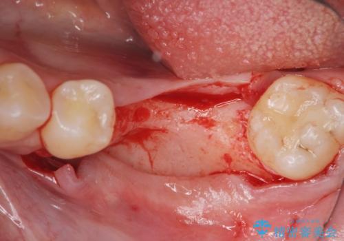 他院で断られた骨造成を伴うインプラント治療の治療中