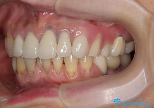[ノンクラスプデンチャー]  バネの見えない審美的な入れ歯の症例 治療後