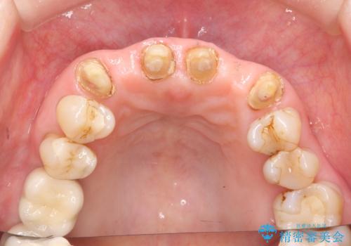 不自然な前歯ブリッジ ジルコニアブリッジによるやり替えの治療中