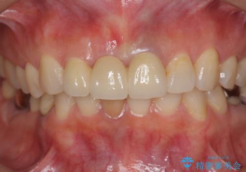 [抜歯時の顎堤保存]  審美的なブリッジ製作の治療後
