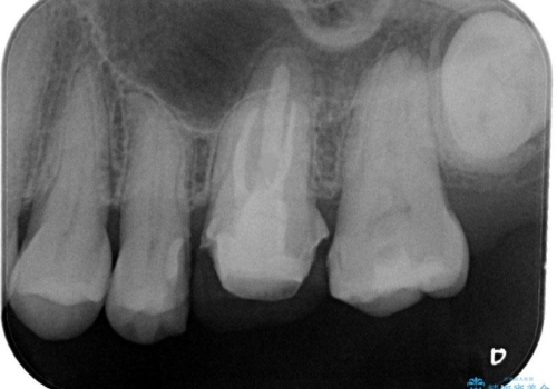 金属をセラミックにしたい、根管治療も行ったケースの治療中