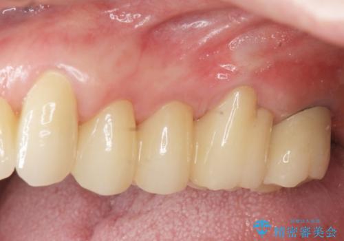 歯ぎしりに抵抗する歯周補綴 インプラント補綴の症例 治療後