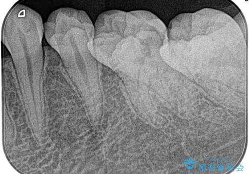 【根管治療】冷たいもので激痛の治療前
