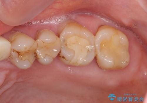 歯ぎしりに抵抗する歯周補綴 インプラント補綴の治療前